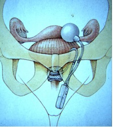 Injection of bulking agent in urethra using an endoscope